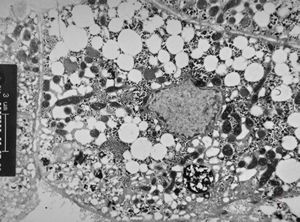 M,15y. | steatosis